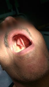 Nadziąślak szczelinowaty